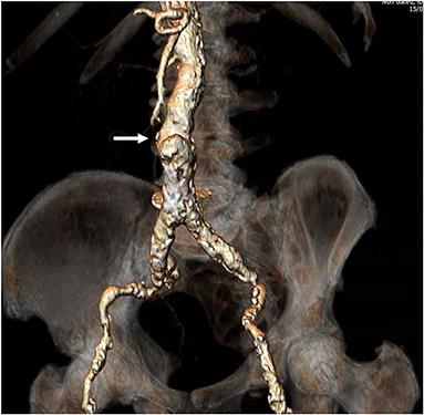 Clinical Outcome and Safety of Transcaval Access for Transcatheter Aortic Valve Replacement as Compared to Other Alternative Approaches